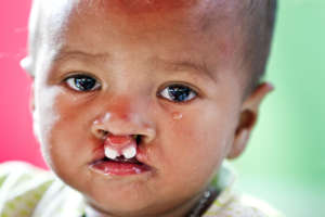 Surgery is about changing tears into Smiles