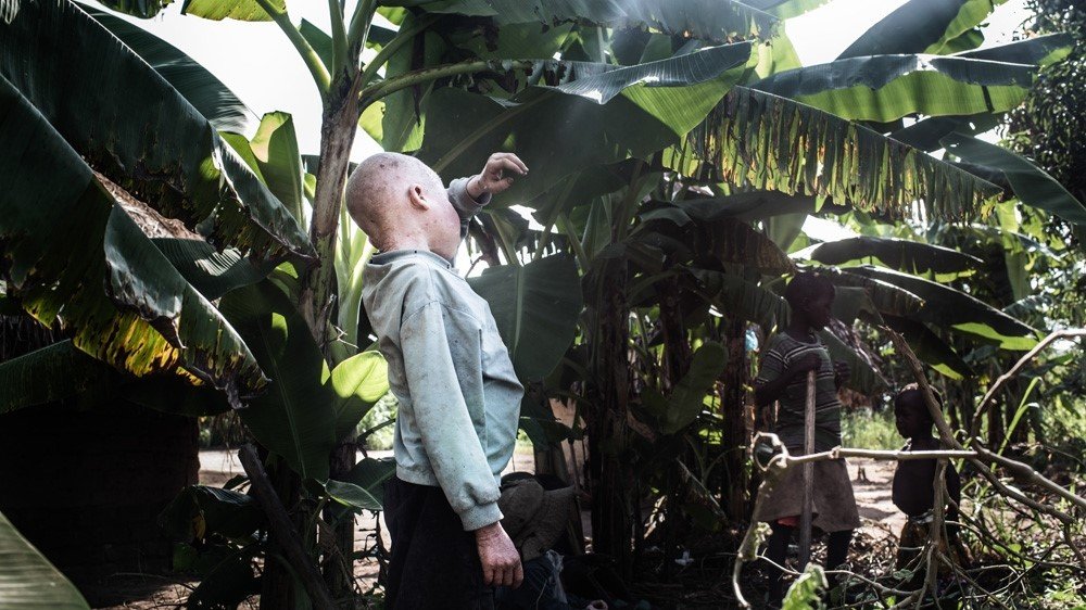 Improving the lives of People with Albinism