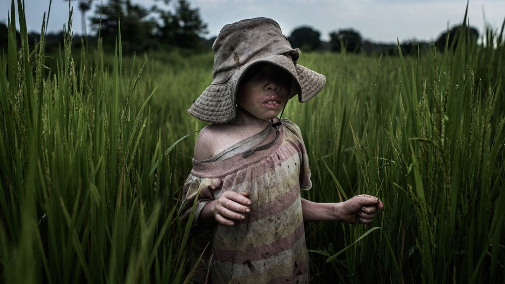 Improving the lives of People with Albinism