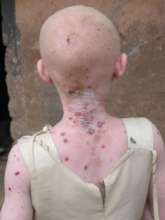 albino child showing her back exposed to sunshine