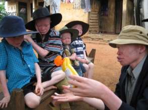 Attending to albino children by adults