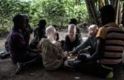 Improving the lives of People with Albinism