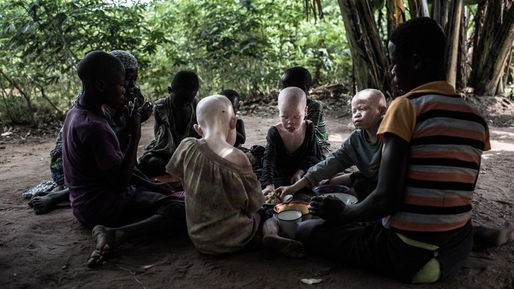 Improving the lives of People with Albinism