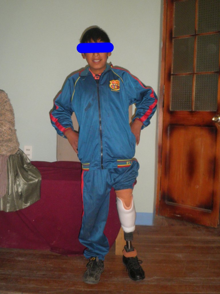 Prosthetic Limbs for 50 Poor Bolivian Amputees