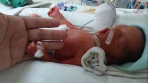 MATEO, a premature baby.