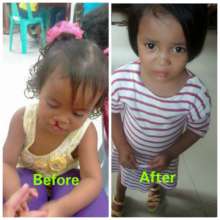 Before and After Facial Surgery