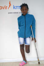 Karen, before her prosthesis
