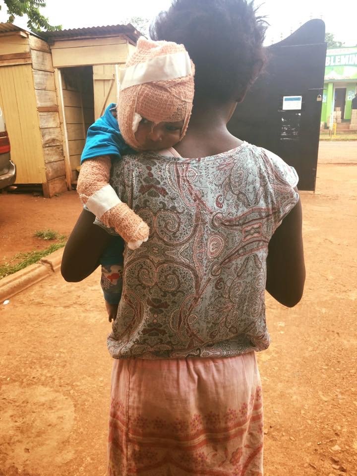 Plastic Surgery for Burn Survivor Baby John