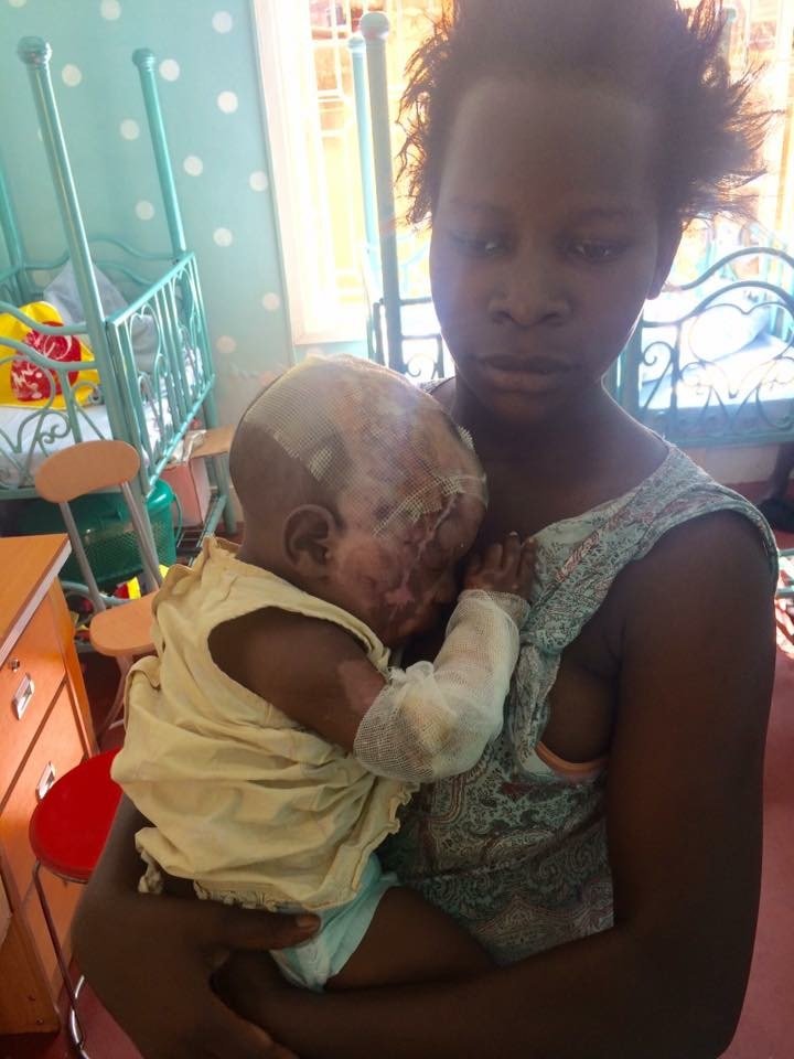 Plastic Surgery for Burn Survivor Baby John