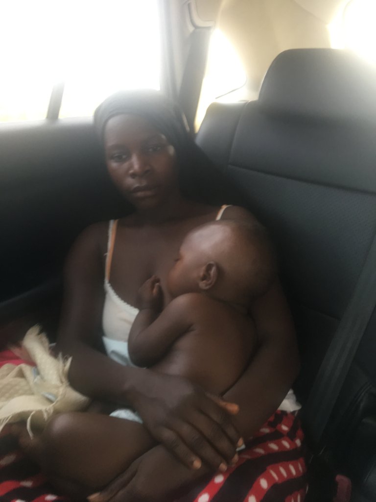 Plastic Surgery for Burn Survivor Baby John