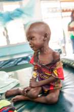 20-month old Naroi in severely malnourished