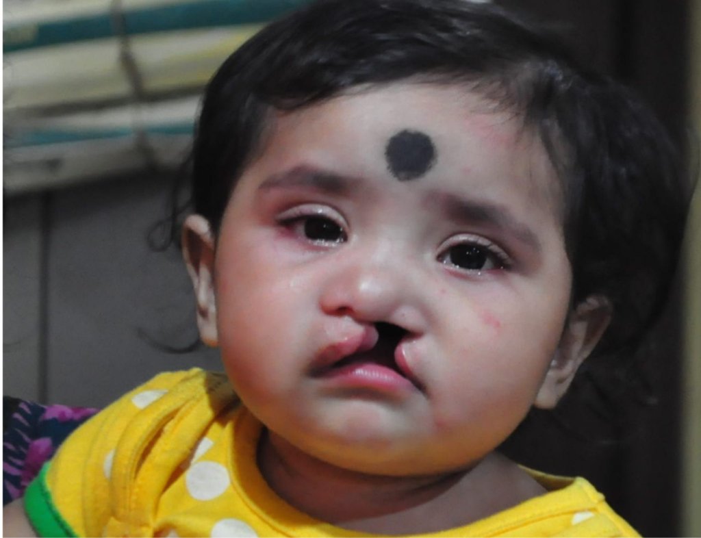 Establish Kolkata Comprehensive Cleft Care Centre