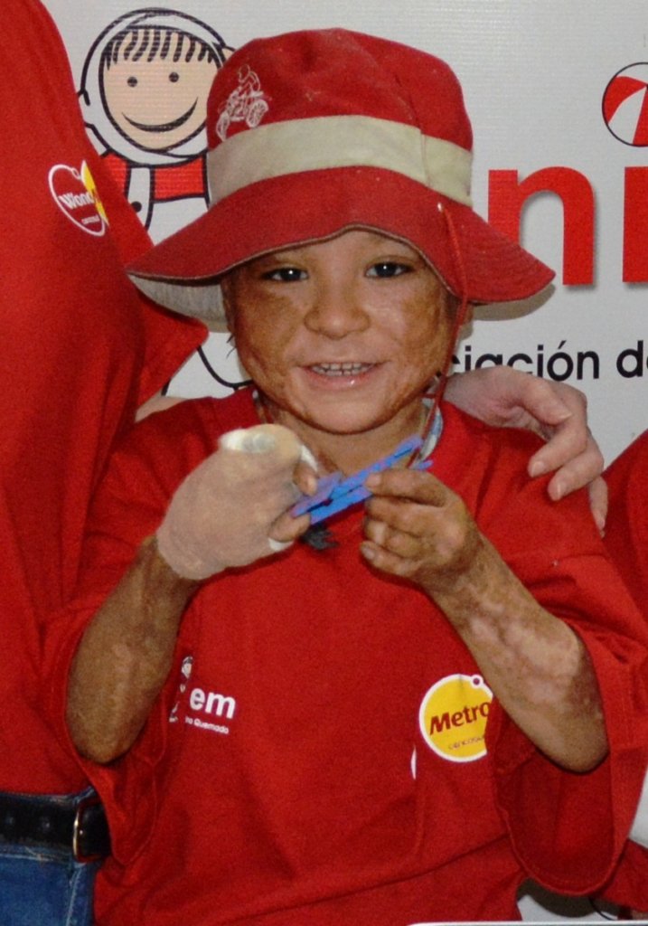 Help Jose-Give a burned child in Peru a new future
