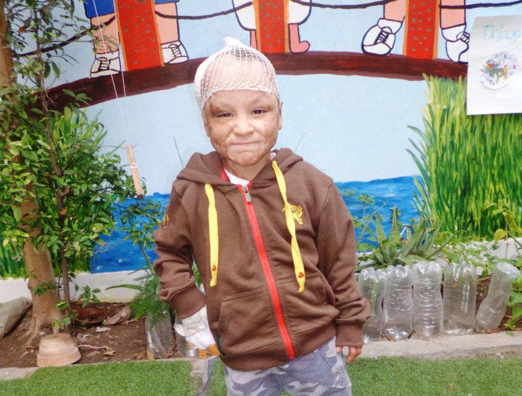 Help Jose-Give a burned child in Peru a new future