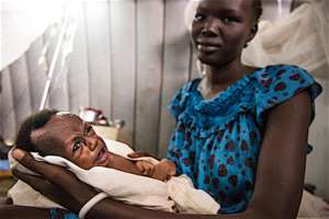 A 2-month old with severe acute malnutrition.