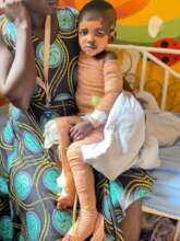 burnt child by her siblings
