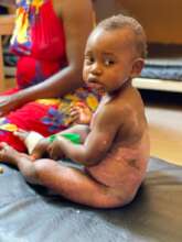 Baby Ella during her healing process at whispers