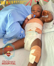 one of our patients for burns