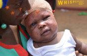 Help Fund a Children's Burn Unit in Uganda