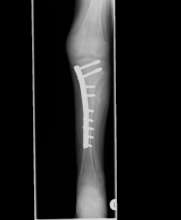 Image showing the disabled leg after operation