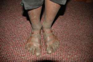 Injuries sustained in the restaurant