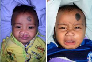 Aman's Transformation from Cleft to Smile