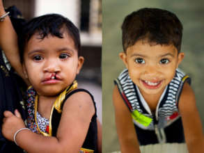 Samina Before and After her surgery