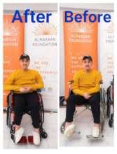Before & after receiving the customized wheelchair