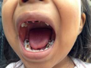 Dental challenge - decay of kids' teeth