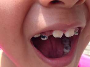 Dental challenge - decay of kids' teeth 2