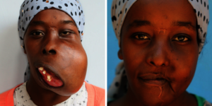 Elili Before and After Surgery