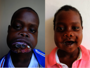 Hafis Before and After his Surgery