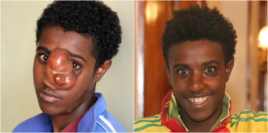 Support Facial Surgery for 50 Ethiopian Children