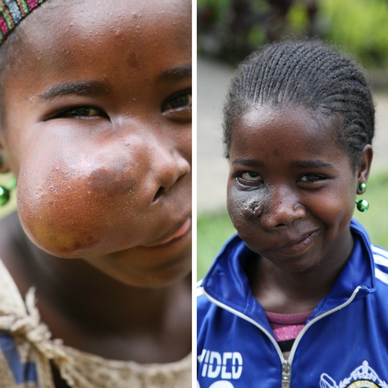 Support Facial Surgery for 50 Ethiopian Children