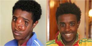 Geremew Before and After Surgery