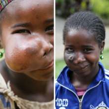 Fami Before and After Surgery