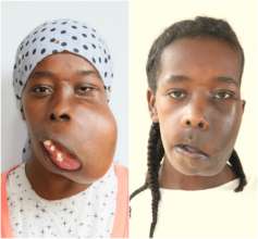Elili Before and After Surgery