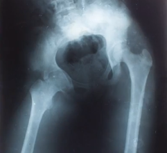 X-ray indicating a healing fractured hip