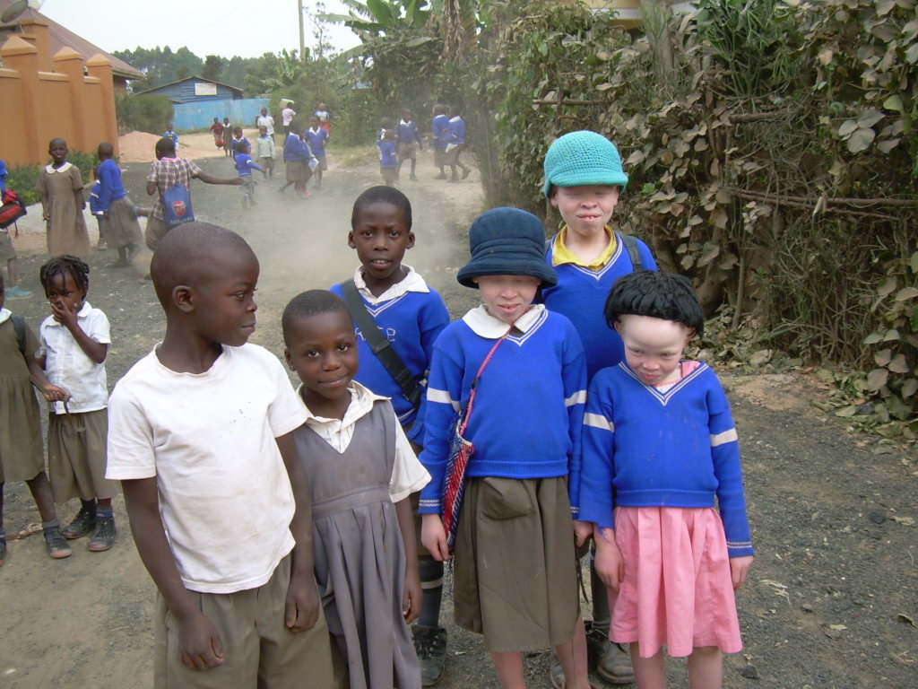Save a Ugandan albino child from Skin Cancer