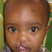 CLeft lip surgery operation
