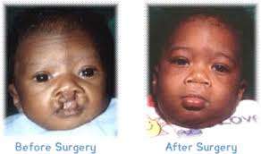 cleft lip palate surgery operation