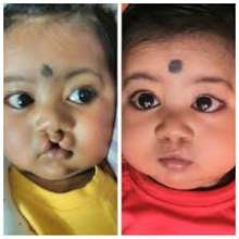 Cleft lip surgery operation