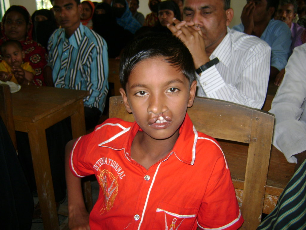 FREE OF COST CLEFT LIP PALATE SURGERY OPERATION
