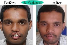 FREE OF COST CLEFT LIP PALATE SURGERY OPERATION