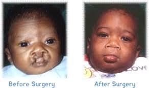 FREE OF COST CLEFT LIP PALATE SURGERY OPERATION