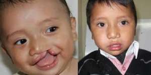 cleft lip surgery