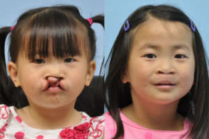 cleft lip surgery