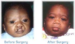 cleft lip surgery