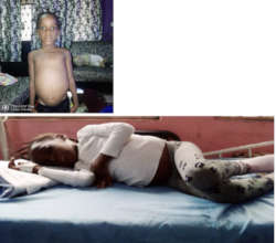 Chijioke (5 year old cancer patient)
