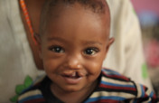 Help a Child with Cleft Smile in Ethiopia